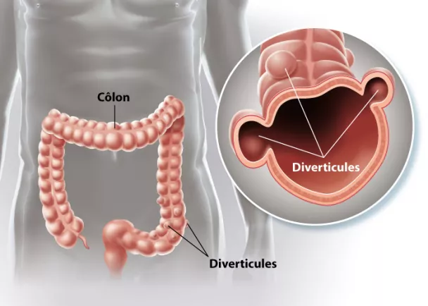 Diverticules du colon | Polyclinique du Beaujolais